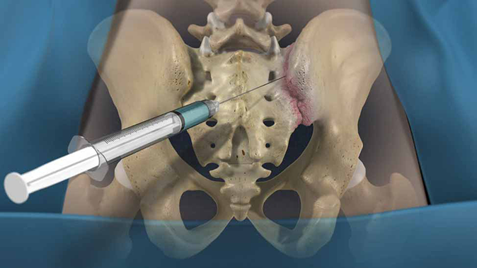 SI Joint Injections