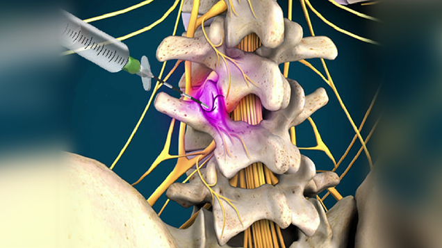 Medial Branch Nerve Block Injections