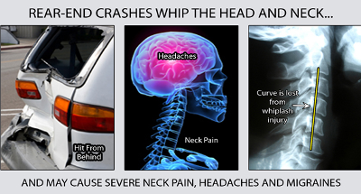Identifying Whiplash Symptoms After a Car Accident