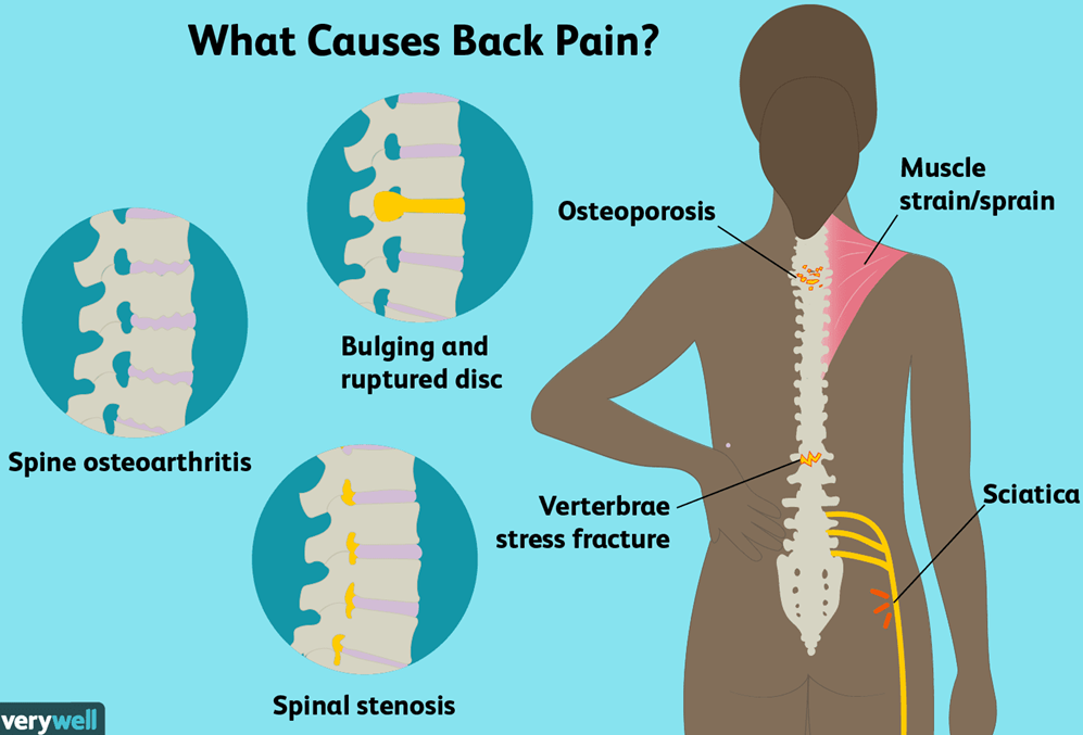 Top Causes of Back Pain