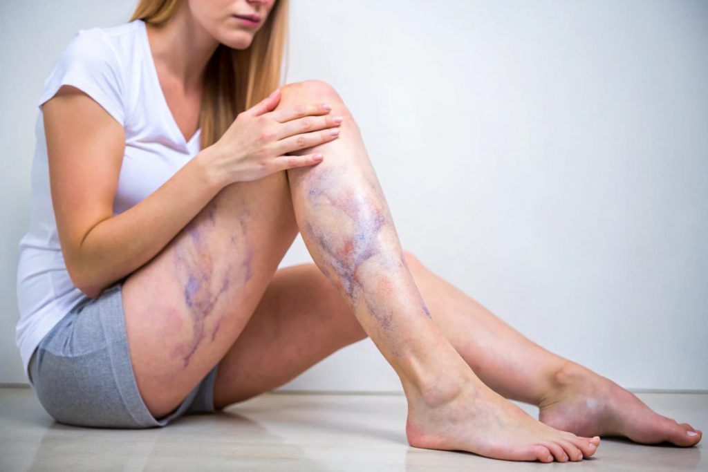 Latest vein treatments 2025