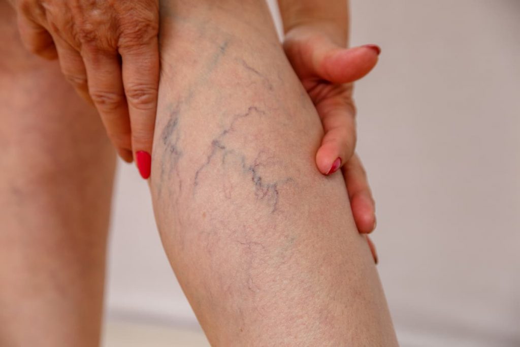 Vein Therapy