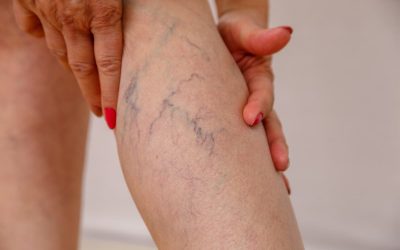 How Advanced Vein Therapy Helps Restore Blood Flow and Relieve Pain