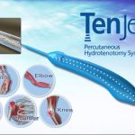 Picture4 1 1 TenJet Tenotomy TenJet Tenotomy Wesley Chapel Spine and Sport Medicine