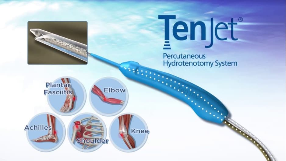 TenJet tenotomy near me