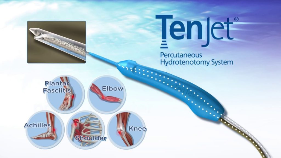 Tendinosis Treatment