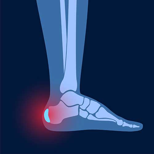 achilles Tenotomy Procedure Tampa FL Tenotomy Procedure Tampa FL,TenJet Tenotomy Wesley Chapel FL,Tenotomy procedure Wesley Chapel,TenJet procedure near me,Sports medicine Wesley Chapel FL,Elbow pain treatment Wesley Chapel Wesley Chapel Spine and Sport Medicine